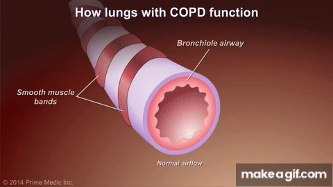 An animation of an airway showing air moving through with COPD